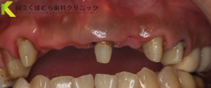 審美歯科症例02治療前