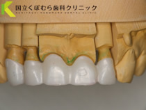 仮歯の作成