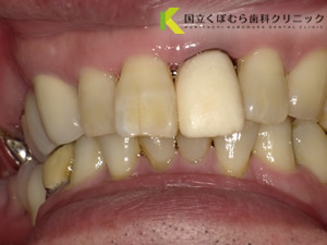 審美歯科症例02治療前