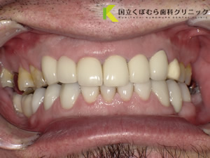 審美歯科症例29治療後