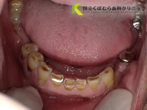 審美歯科症例29治療前
