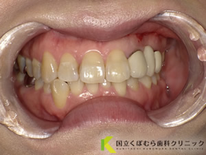 審美歯科症例29治療前