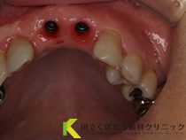前歯のインプラント症例術中01