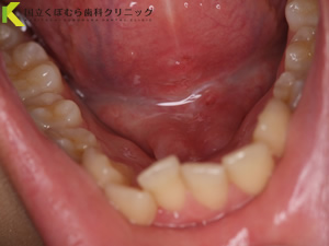 舌小帯切除術術後