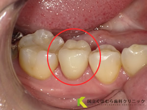 歯の色調に満足されていなかったケース01治療後