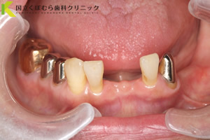 審美歯科症例治療前