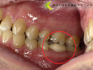 歯の色調に満足されていなかったケース02治療前