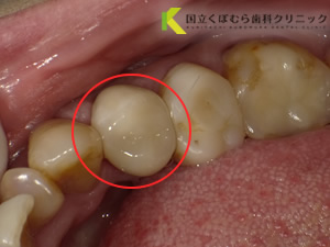 歯の色調に満足されていなかったケース03治療後