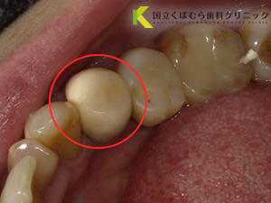 歯の色調に満足されていなかったケース03治療前