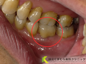 歯の色調に満足されていなかったケース03治療後