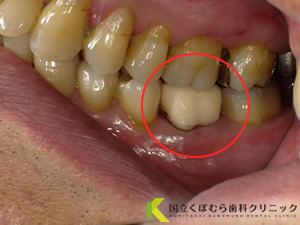 歯の色調に満足されていなかったケース03治療前