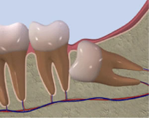 親知らずが歯ぐきの中に潜ったままになっている場合