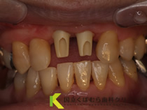 前歯のインプラント症例術中02