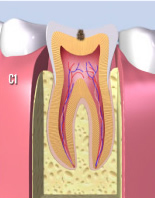 虫歯の進行C1