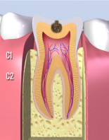 虫歯の進行C2