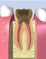 虫歯の進行C3