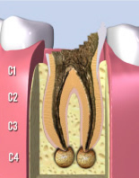 虫歯の進行C4