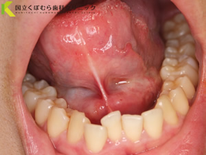 舌小帯切除術術前