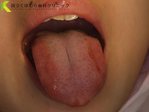 舌小帯切除術術後：舌が通常通り出る