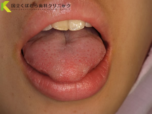 舌小帯切除術術前：舌が通常より出ない
